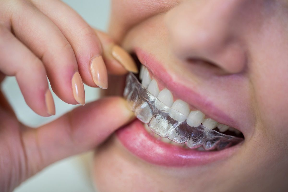 Invisalign: Evolution of Braces