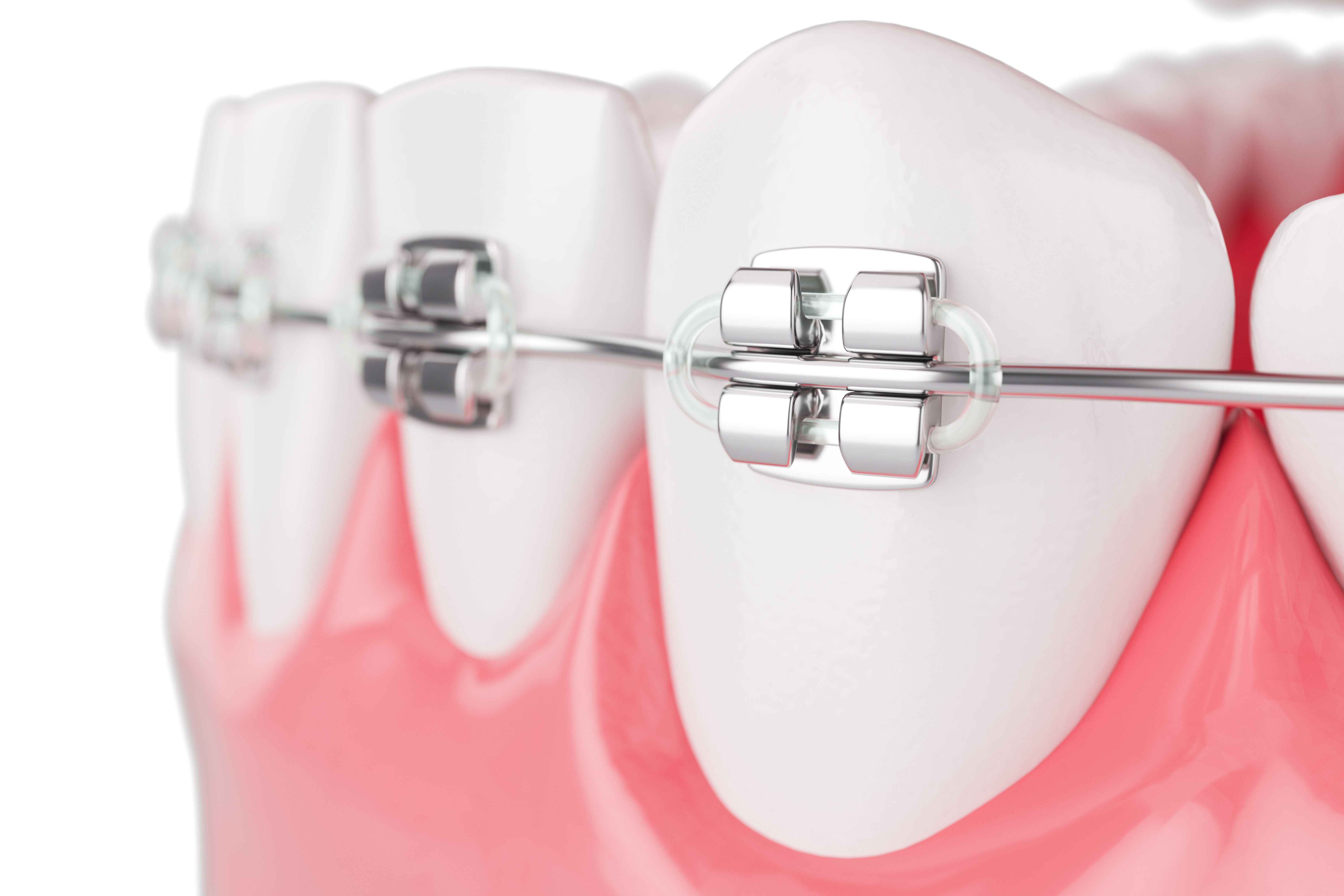 Life with Braces: A Guide to Eating, Speaking, and Daily Care for Adults