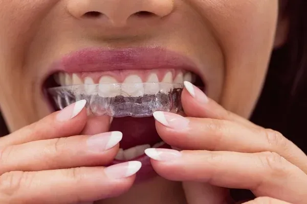 Types of Invisalign Treatment