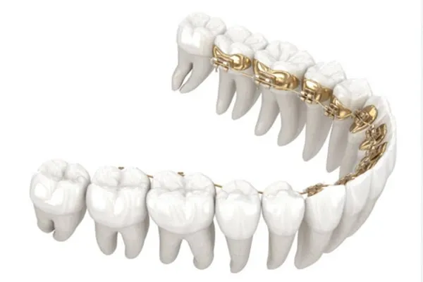 What Are Lingual Braces and How Do They Correct an Overbite